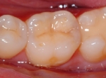 #30 Class II composite