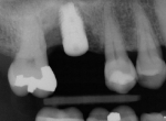 Implant Planning Process