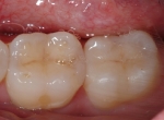 Porcelain Onlay Lower Molar