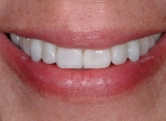 Smile Makeover
