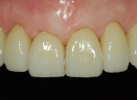 8 Upper Veneers